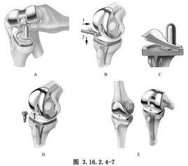 旋轉鉸鏈式膝關節假體置換術