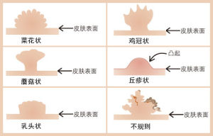 陰部增生物