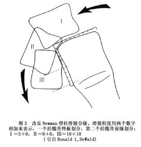 （圖）腰部峽部崩裂和脊椎滑脫