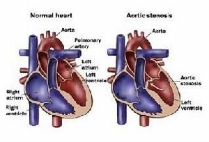先天性主動脈瓣上狹窄