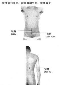 前列腺增生症