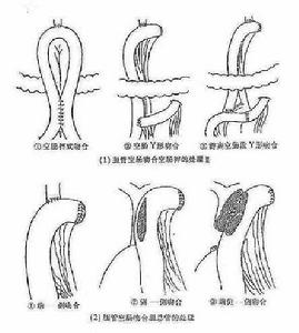 妊娠合併急性膽囊炎