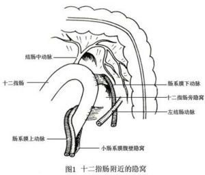 十二指腸旁疝 圖1