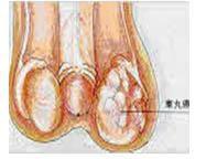 睪丸腫瘤腹膜後淋巴結清掃術