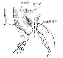 肺動脈瓣關閉不全