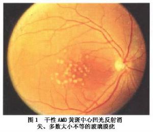 增齡性黃斑變性