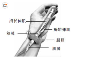 腱鞘炎