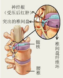 重複使力傷害症