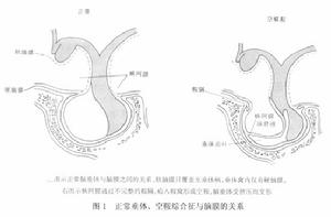 空泡蝶鞍綜合症