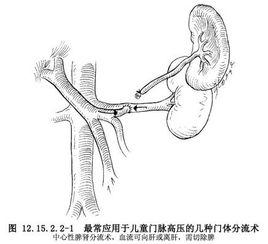 中心性脾腎靜脈分流術