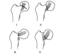 股骨頸骨折分型