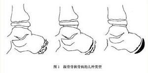 跟骨骨骺骨軟骨病  檢查