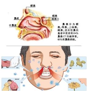 鼻炎