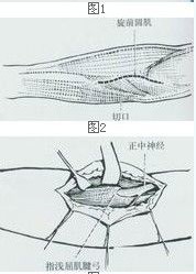 前臂骨間掌側神經卡壓綜合徵松解術