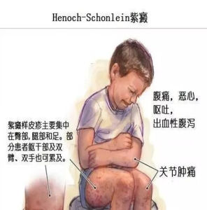 小兒過敏性紫癜