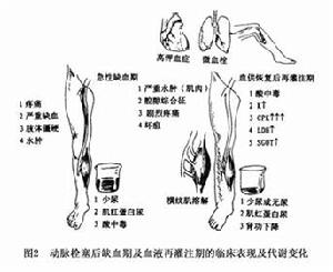 肌病腎病性代謝綜合徵