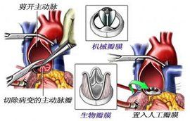 體外循環