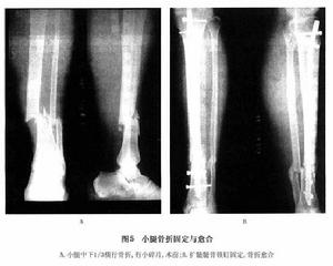 （圖）脛腓骨骨幹骨折