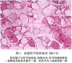 散發性甲狀腺腫