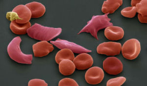 鐮狀細胞貧血