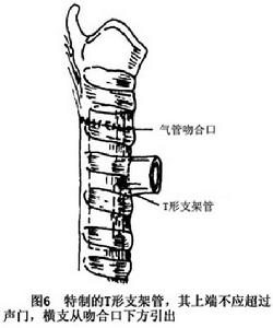 創傷性氣管及主支氣管損傷