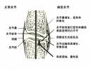 軟骨代謝障礙病