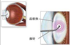 糖尿病白內障