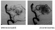 腦血管栓塞