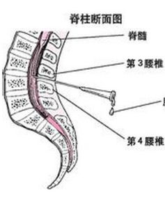 急性脊髓炎