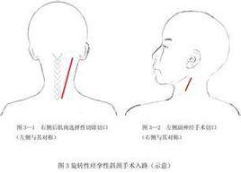 痙攣性斜頸的定向手術