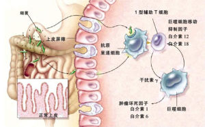 蛋白丟失性胃腸病