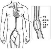 血管成形術對動脈的影響