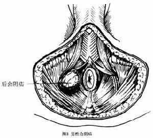 會陰疝 圖3
