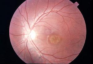 （圖）視網膜炎
