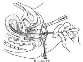刮宮手術