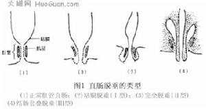 直腸糜爛