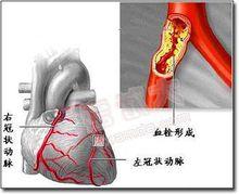 纖維蛋白性心包炎