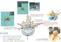 椎間孔鏡路入的椎間盤突出橫切面圖解