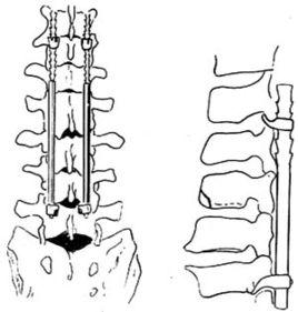 脊柱骨折脫位