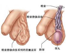 精索靜脈曲張