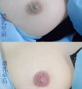 乳暈嫩紅術 讓乳暈宛若初生嬌蕾