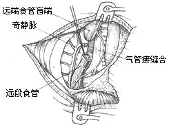 氣管先天性疾病