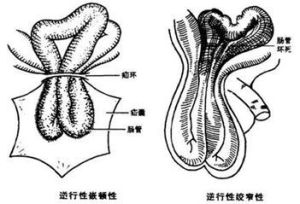 絞窄疝