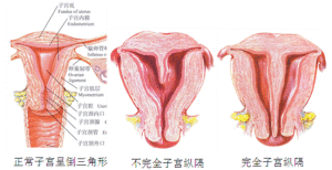 子宮縱隔