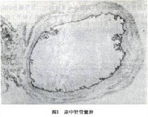 卵巢冠囊腫