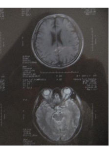 多發性腦梗塞