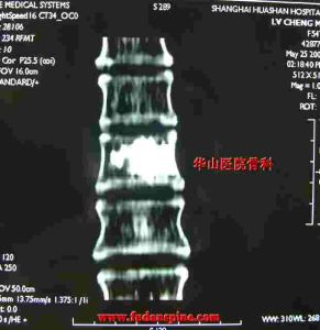 《經皮椎體成形術》