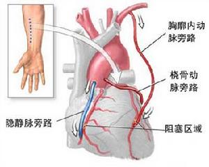 心臟搭橋手術