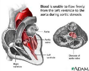 先天性主動脈瓣上狹窄
