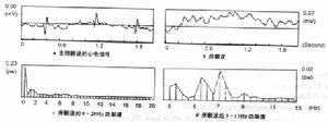 （圖）心房顫動動率譜：屈天祥患有該病